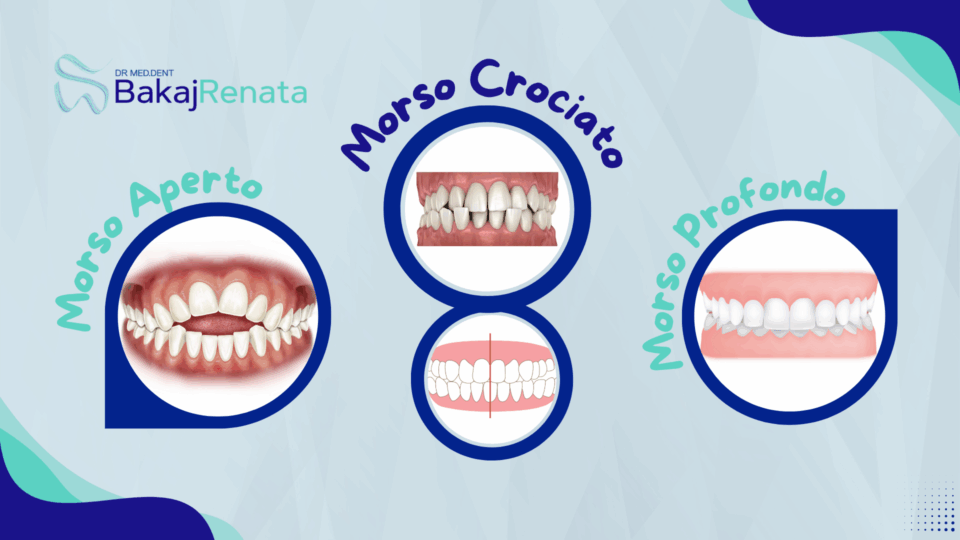Morso Aperto, Profondo o Crociato: Che Cos’è e Come si Corregge | Studio Bakaj Lugano