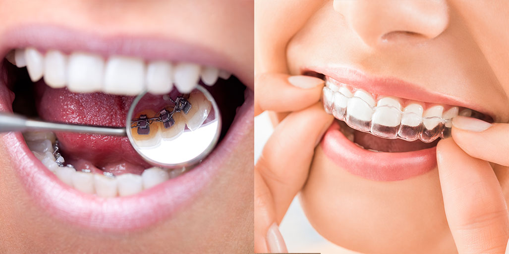 Ortodonzia Estetica e Invisibile per Adulti a Lugano | Studio Bakaj Ortodonzia Estetica e Invisibile per Adulti a Lugano | Studio Bakaj