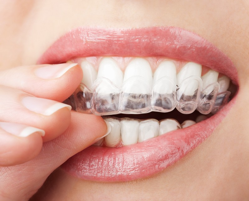 Invisalign Teen: Allineatori Trasparenti per Adolescenti a Lugano | Studio Bakaj Invisalign Teen: Allineatori Trasparenti per Adolescenti a Lugano | Studio Bakaj