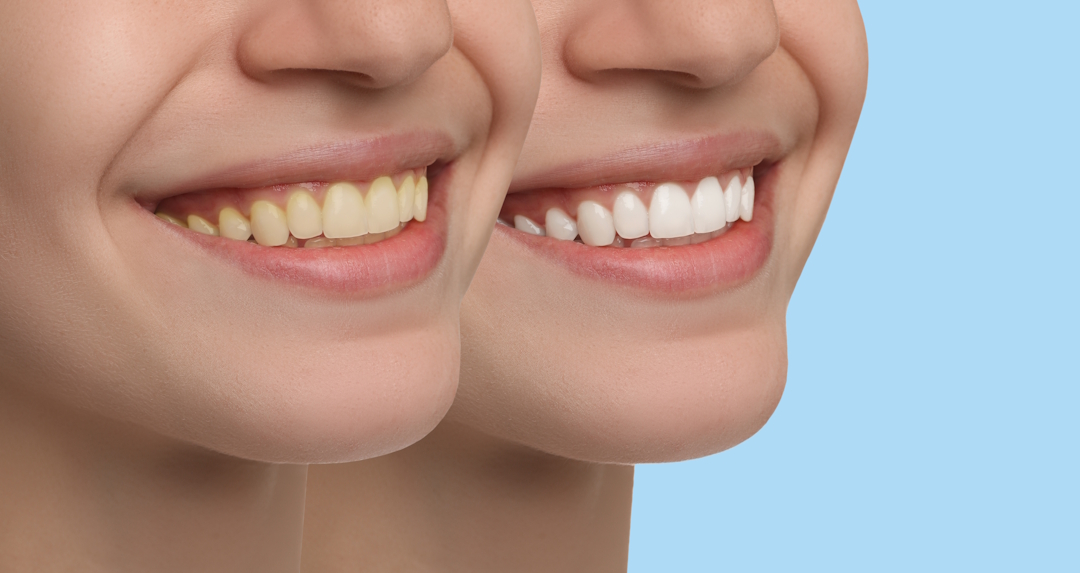 Sbiancamento Dentale Professionale alla Poltrona a Lugano | Studio Bakaj Sbiancamento Dentale Professionale alla Poltrona a Lugano | Studio Bakaj