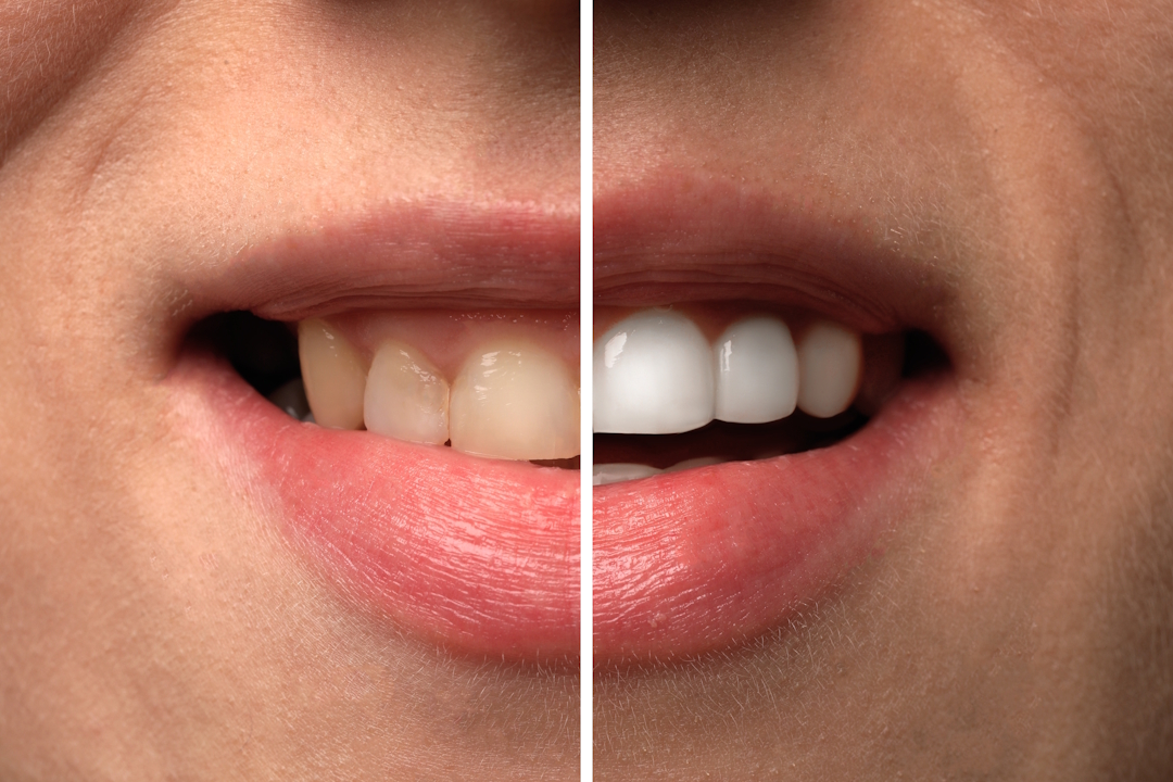 Sbiancamento Dentale Professionale a Lugano | Studio Bakaj Sbiancamento Dentale Professionale a Lugano | Studio Bakaj