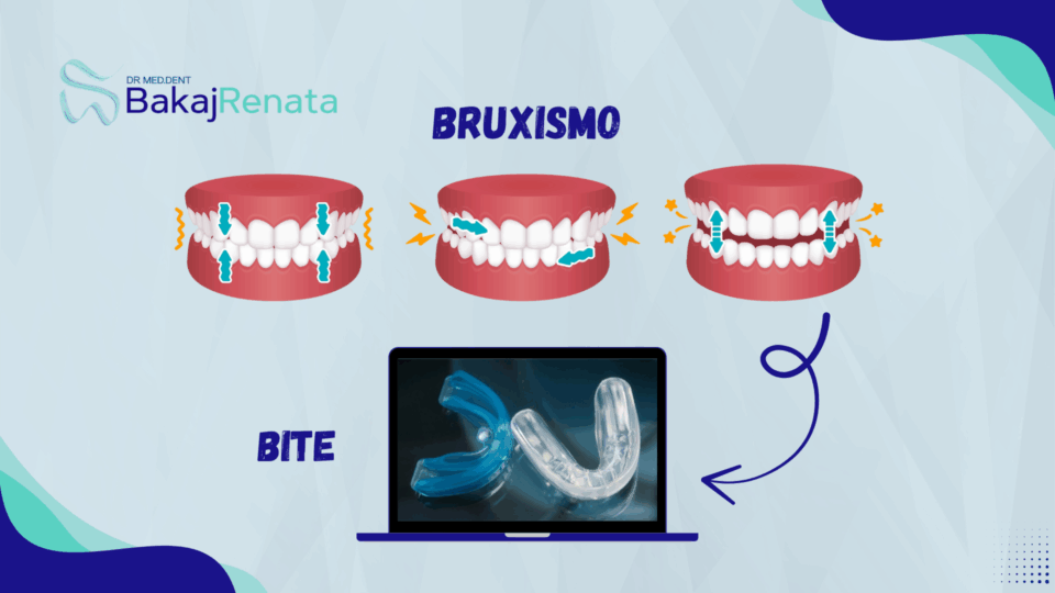 Bite Dentale: Quando Serve, Come Funziona e Perché È Utile | Studio Bakaj Lugano
