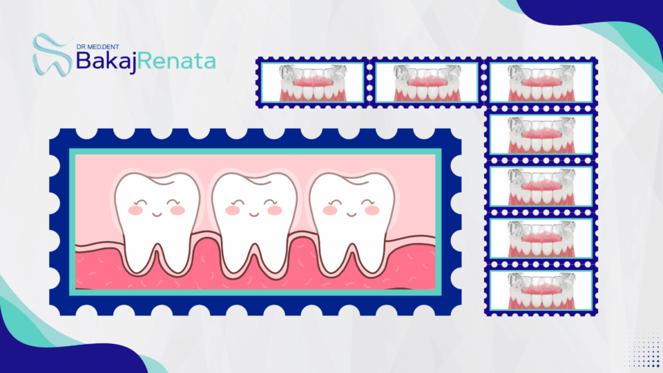 Invisalign per Adolescenti a Lugano: libertà, comfort e un sorriso perfetto